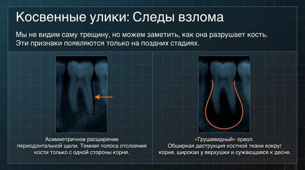 Невидимая трещина разрушает кость