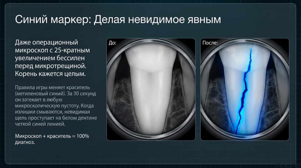 Окрашивание метиленовым синим маркером выявляет трещину в зубе