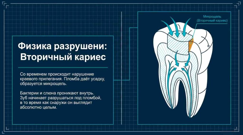 Почему пломба со временем перестаёт держать